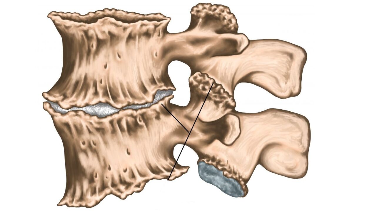 spinal lesions due to osteochondrosis
