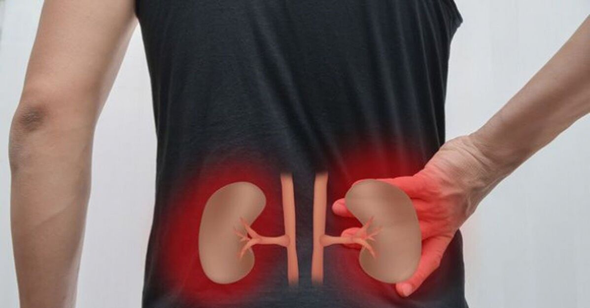 Inflammation of the kidneys may cause lower back pain