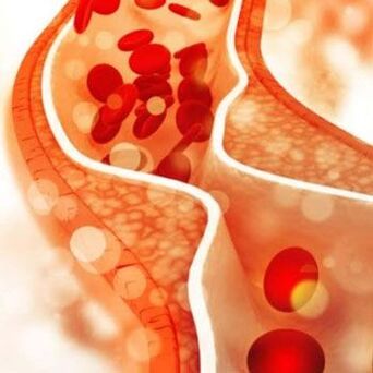 Deposition of cholesterol on the inner walls of blood vessels provokes pain in the side of the neck